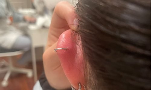 Red, swollen ear piercing infection